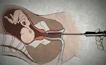 lethal injection planned parenthood abortion.png