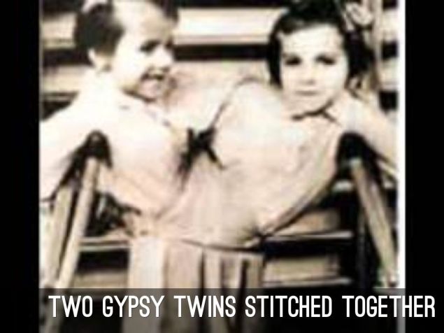 mengele-twin-gypsies-sewn-together