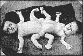 mengele-twins-sewn-together